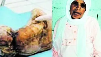 ÎNSĂRCINATĂ JUMĂTATE DE SECOL: O femeie din Maroc a purtat în pântece un fetus pietrificat
