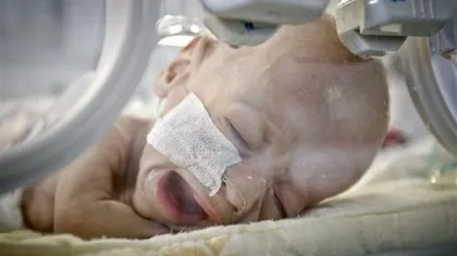 Bebeluşul român născut fără intestine a murit. Medici: a fost o minune că a supravieţuit 9 luni