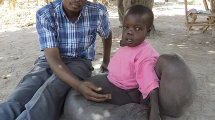 Un băiat din Uganda are o boală care i-a făcut picioarele 