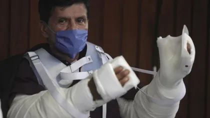 Dublu transplant de mâini realizat de medicii mexicani