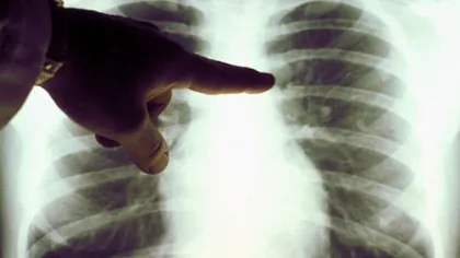 România are cel mai mare număr de cazuri de TBC din UE. 77 de oameni se îmbolnăvesc zilnic