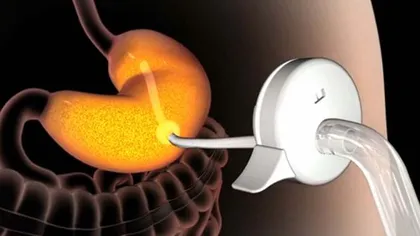 Invenţia secolului: Pompa care te scapă direct din stomac de tot ce mănânci şi bei VIDEO