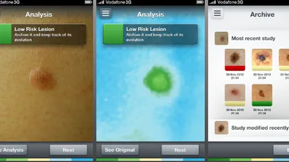 SkinVision, aplicaţia de mobil care poate detecta aluniţele periculoase