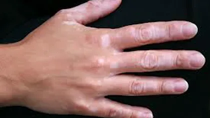 S-a descoperit un posibil remediu pentru vitiligo