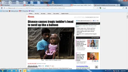 Extraterestrul din India: Vezi fetiţa cu capul de trei ori mai mare decât cel al unui copil normal