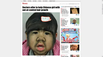 Cazul dramatic al unei fetiţe cu păr pe faţă, în atenţia medicilor chinezi