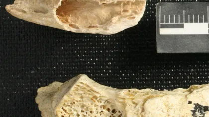 Cea mai veche tumoare a unui hominid, identificată la o coastă de neanderthalian