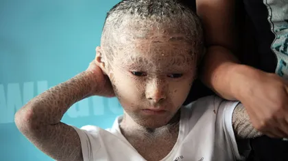 Povestea băiatului-PEŞTE, cu pielea acoperită de solzi. Medicii nu pot să-l vindece