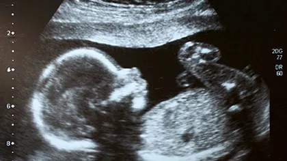 Caz UNIC în istoria medicinei: Tânără însărcinată, află în COMĂ de o LUNĂ, ar putea deveni MAMĂ VIDEO