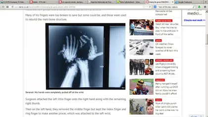 Mâinile i-au fost CIOPÂRŢITE într-un accident, dar medicii au reuşit un MIRACOL. Vezi cum arată după operaţie