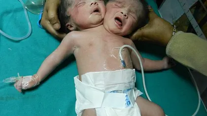 Dramă pentru o femeie prea săracă să îşi facă o ecografie: A născut un bebeluş cu două capete FOTO