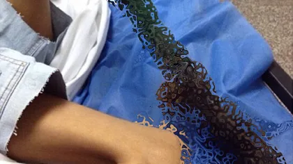 O fetiţă muşcată de ŞARPE s-a trezit cu piciorul PUTREZIT, după ce a fost tratată cu leacuri băbeşti