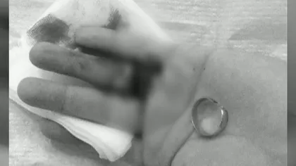 Un bărbat riscă să rămână fără deget din cauza verighetei VIDEO