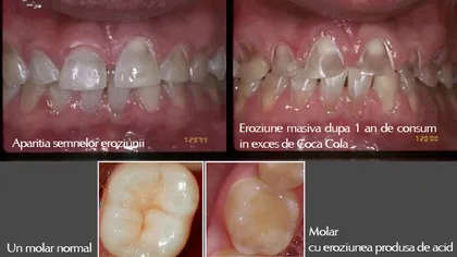 EXPERIMENT: Cum arată un dinte ţinut în Cola. VIDEO