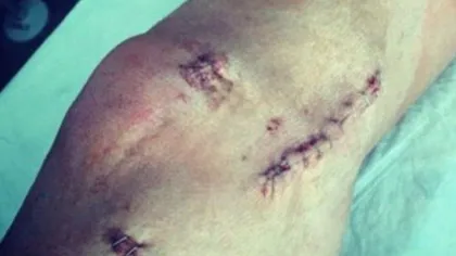 IMAGINI HORROR cu genunchiul lui Andy Carroll după operaţie FOTO