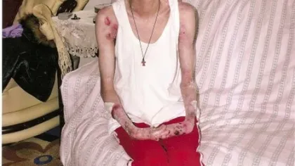 O tânără de 35 de ani STRIGĂ DUPĂ AJUTOR! Oana suferă de o maladie rară care îi macină pielea şi oasele