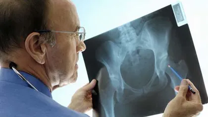Despre osteoporoză: Tot ce trebuie să ştii despre 