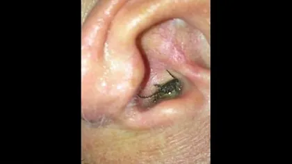 Un american a descoperit cu ajutorul unui iPhone ca are un paianjen în ureche. Cum a reacţionat. VIDEO