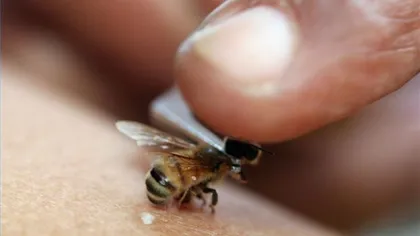Pas cu pas ce trebuie să faci dacă te înţeapă o albină sau o viespe