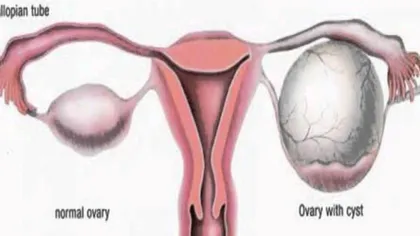 8 moduri simple de a scăpa de chisturile de pe ovare în mod natural