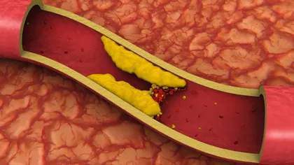 Lucruri pe care nu le ştiai despre colesterol