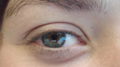 Şase afecţiuni care pot fi detectate printr-o simplă analiză a ochilor