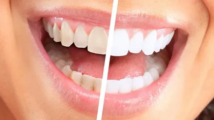 Cum să-ţi albeşti dinţii fără ingrediente toxice