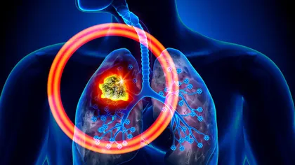 Cancerul pulmonar. 8 simptome pe care nu ar trebui să le ignori