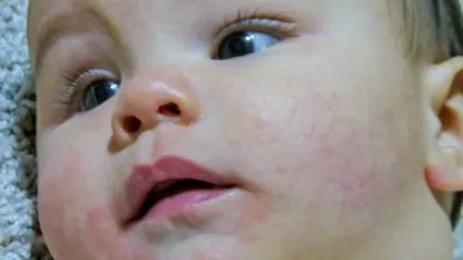 Dermatita atopică. Cum scăpăm copiii de pielea roşie, iritaţii, mâncărimi şi vezicule suprainfectate
