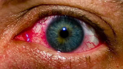 Un bărbat a fost diagnosticat cu cancer la ochi deoarece făcea asta noaptea