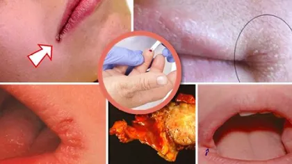 Toate femeile ignoră rănile din colţul gurii, dar uite cât de PERICULOASE pot fi