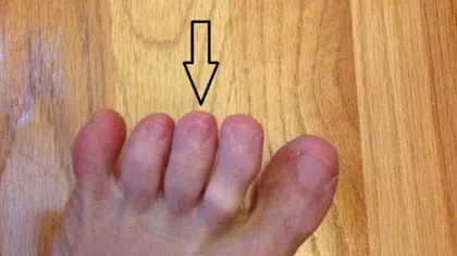 Cancerul de piele poate fi anunţat de degetele de la picioare. Află cum!