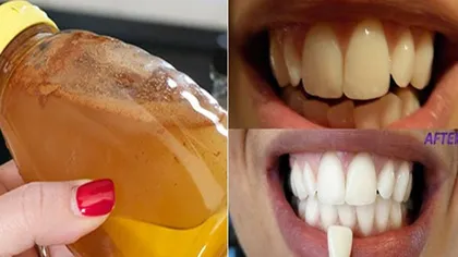 Fă gargară cu acest ingredient simplu şi vezi ce lucru uimitor se întâmplă cu dinţii tăi