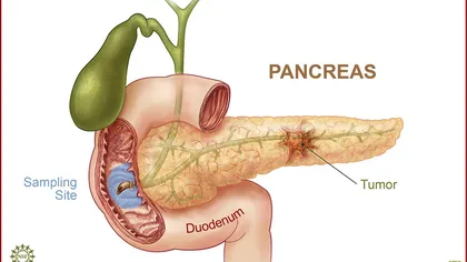 A fost creat primul tratament împotriva cancerului pancreatic, fără efecte secundare