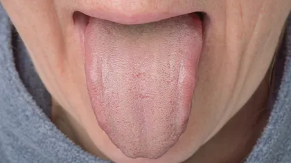 Ai limba crăpată, pătată, umflată sau albă? Vezi ce probleme de sănătate îţi indică felul în care arată limba ta