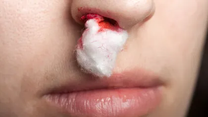Nu te întinde la orizontală când îţi curge sânge din nas