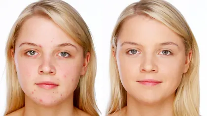 Trucuri de make-up pentru femeile cu acnee