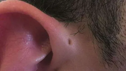 Află ce semnifică gaura mică de deasupra urechii pe care unii oameni o au