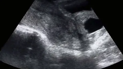 A rămas însărcinată, însă a primit o veste teribilă la prima ecografie! Uite ce lucru îngrozitor i s-a întâmplat