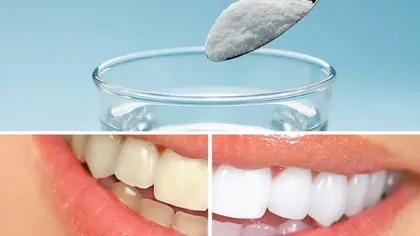 Albirea dentară acasă sau la stomatolog. Iată ce trebuie să alegi în această primăvară