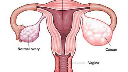 Simptome ale cancerului ovarian pe care nicio femeie nu ar trebui să le ignore