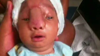 Copilul ăsta s-a născut cu creierul în afara craniului! Cum arată acum, după o operaţie de şase ore care i-a salvat viaţa!