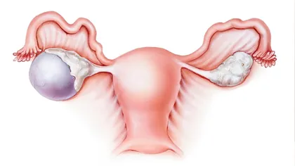 Un nou tratament împotriva cancerului ovarian dă rezultate