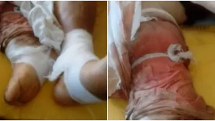Caz incredibil la un spital din Caransebeş. O pacientă a fost ţinută cu acelaşi pansament timp de câteva zile VIDEO