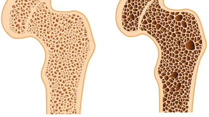 Alimente care ajută la fixarea calciului în oase şi previn osteoporoza