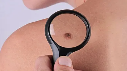 Simptome ascunse ale cancerului de piele