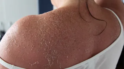 Ce să faci când ţi se jupoaie pielea de la soare