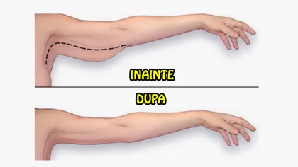Scapă de pielea lăsată de pe braţe fără chirurgia estetică. Este foarte uşor!