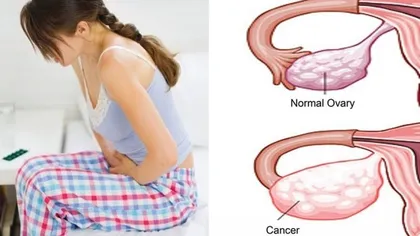 Simptomele cancerului ovarian, 