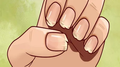 Ce spun unghiile tale despre sănătatea ta. Ce înseamnă când îţi rozi unghiile